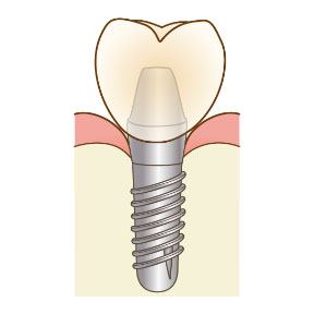 インプラント